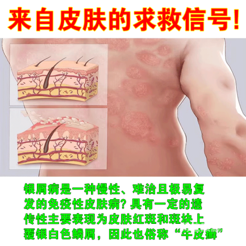 如何判断是阴囊湿疹还是股癣？如何判断是阴囊湿疹还是股癣呢